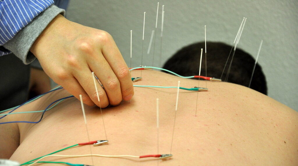 Health Benefits Of Acupuncture