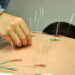 Health Benefits Of Acupuncture